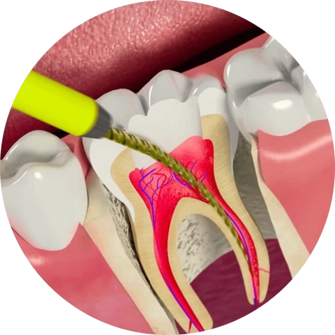 Баннер Лечение каналов — пульпита и периодонтита Баннер Лечение каналов — пульпита и периодонтита